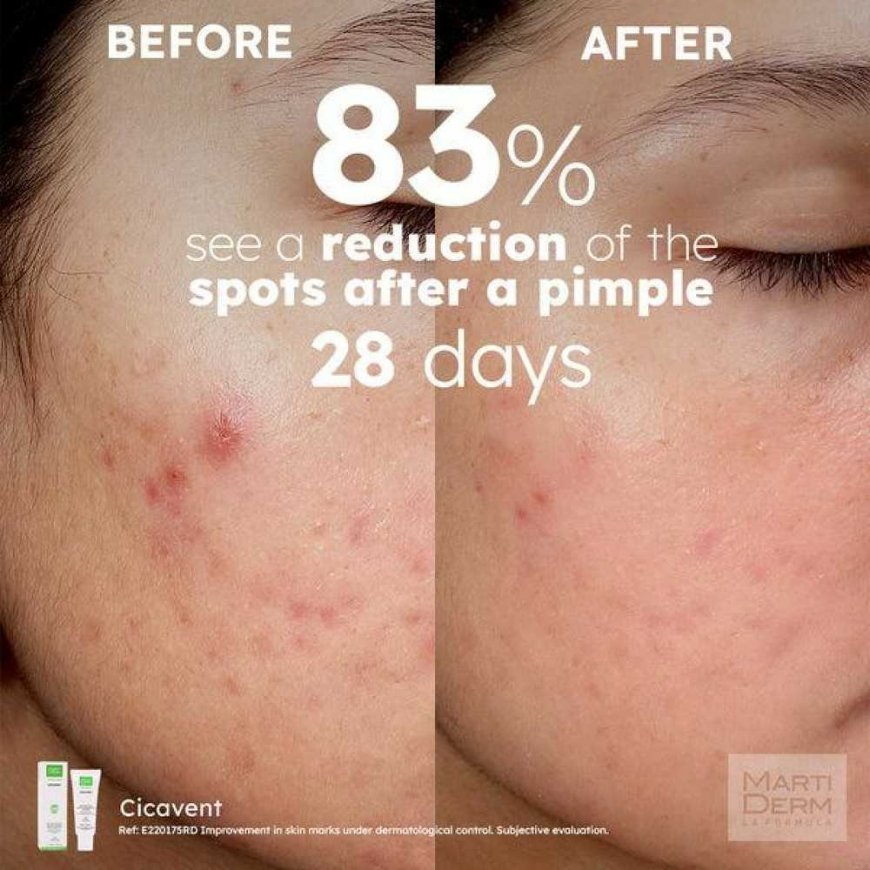 MartiDerm Acniover Cicavent крем для лица, 40 мл – 3
