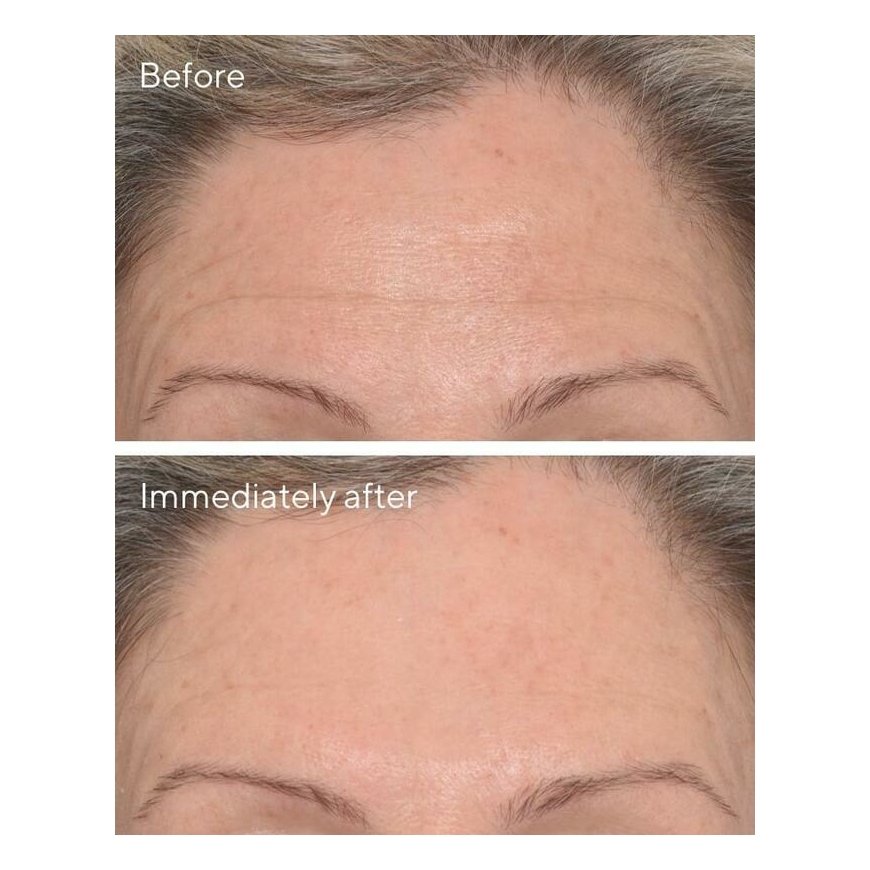 Murad Targeted Wrinkle Corrector 15ml – 4