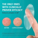 Iroha ACNE PRONE SKIN hydrocolloid patches XL 5 pcs. Iroha ACNE PRONE SKIN hydrocolloid patches XL 5 pcs.