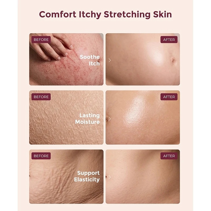 MOMCOZY STRIAE-RELIEVING BODY CREAM WITH COLLAGEN, 30 G – 4